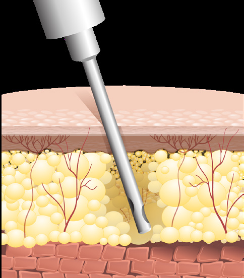 Optimaler Kompressionsdruck von 17–20 mmHg für schnelle Heilung nach Operationen